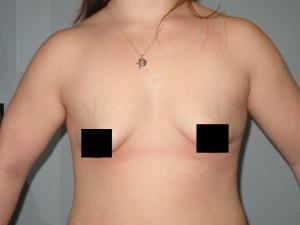 Patient Scheduled For Buttocks Fat Transfer Liposuction Woman looking forward to her fat transfer liposuction surgery.