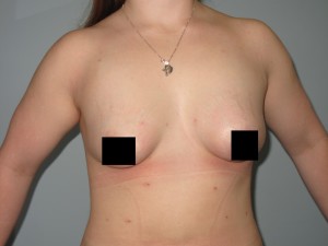 Result Seen From Our Fat Transfer Treatment What one of our fat transfer operations can do for our patients.