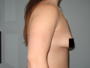 Before this Patient's Abdominal Fat Transfer Procedure The female body before undergoing one of our fat transfer procedures.