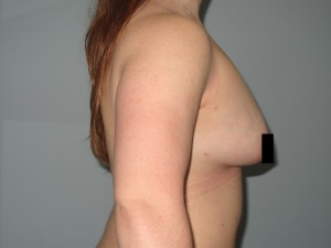 After Fat Transfer of the Abdomen A woman who underwent a fat transfer procedure at our liposuction center.