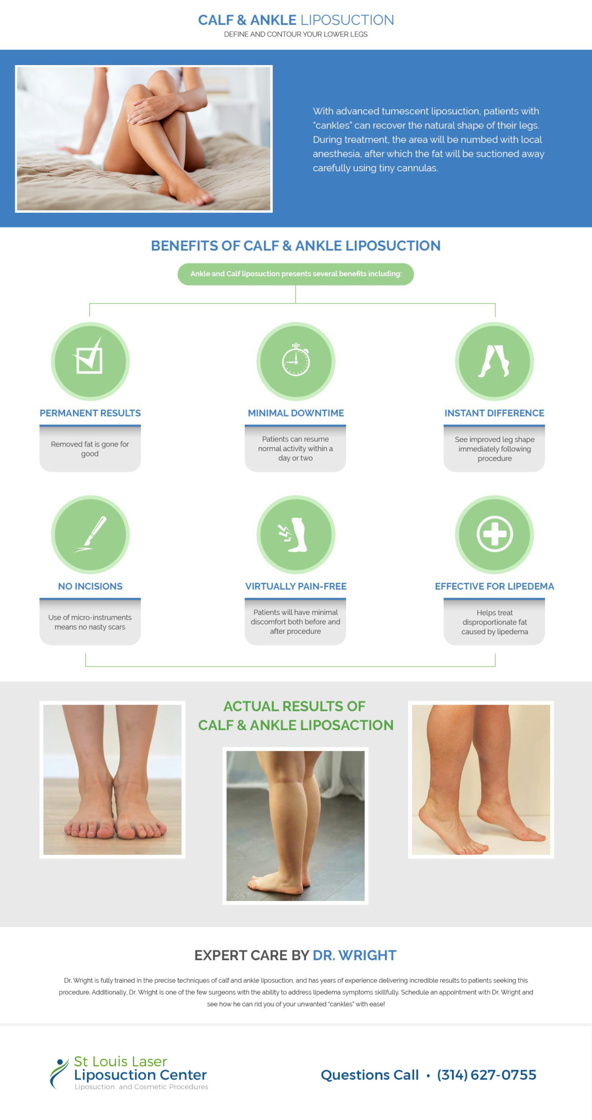 Calf and Ankle Liposuction Area St. Louis Lipo