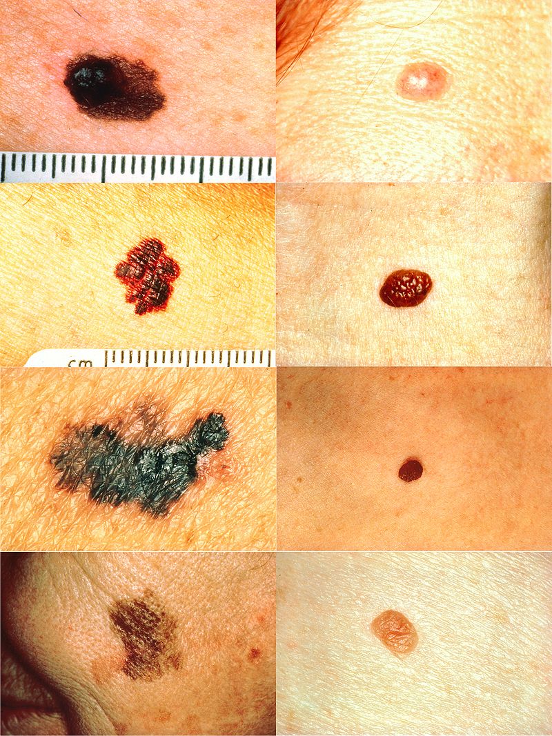 Skin Sun Damage and Mole Removal Dermatologist St. Louis