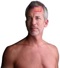Male Diagnosed by a St. Louis Dermatologist Man who has been diagnosed by a highly rated St. Louis dermatologist.