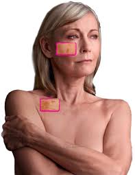 Woman Who Visited a St. Louis Dermatologist Woman who came in to see a St. Louis dermatologist at the St. Louis laser Liposuction Center.
