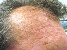 Discoloration From Sun Damage What too much sun exposure can do to the skin.