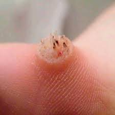 Patient That Came in For Wart Removal A common wart located on the patient's left thumb.