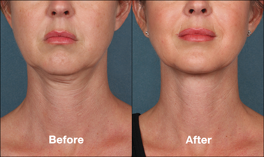 Effects of Kybella on the Female Neck Woman who opted to undergo the Kybella treatment at our St. Louis office.