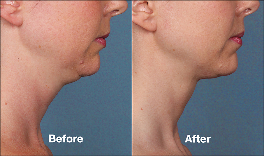 Skin Tightening from the Kybella Treatment The amazing effects that Kybella can have on a female patient.