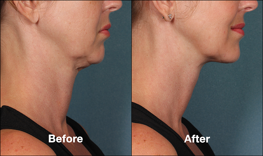 The Results Seen From Our Kybella Treatment Female patient who experienced amazing results after undergoing the Kybella treatment.