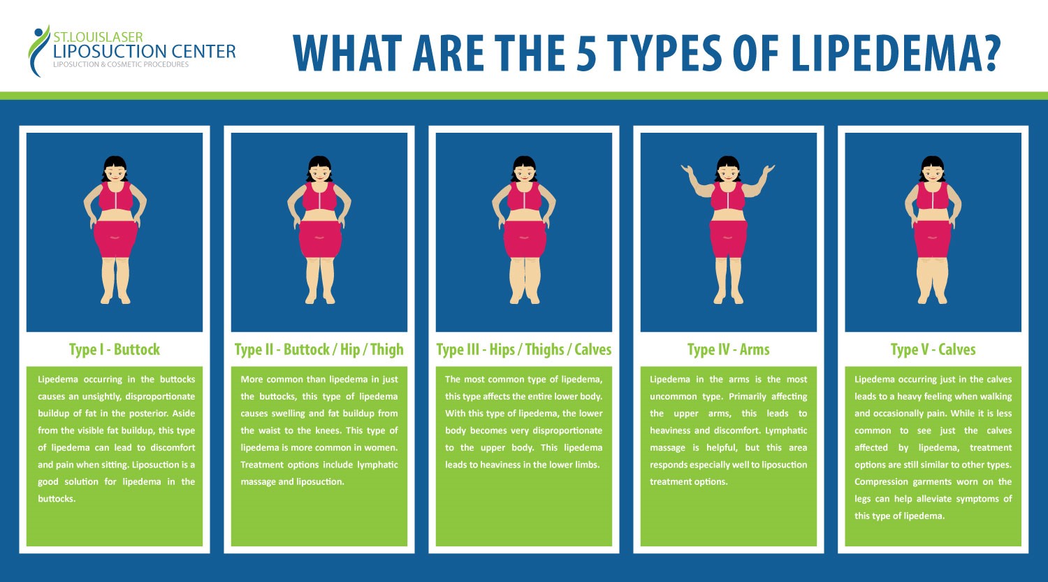 Lipedema Symptoms Stages Treatment St Louis Liposuction Center