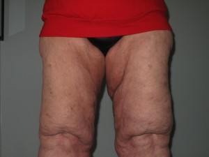 Firsthand Look at Lipedema Symptoms What the most common lipedema symptoms often look like.