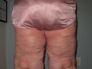 Patient in Need of a Lipedema Treatment A patient who has chosen a lipedema treatment to rid her legs of unwanted subcutaneous fat.