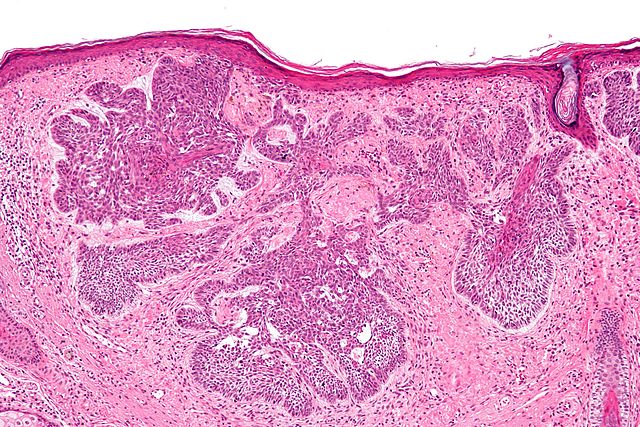 Basal Cell Carcinoma What Basal Cell Carcinoma looks like on a microscopic level