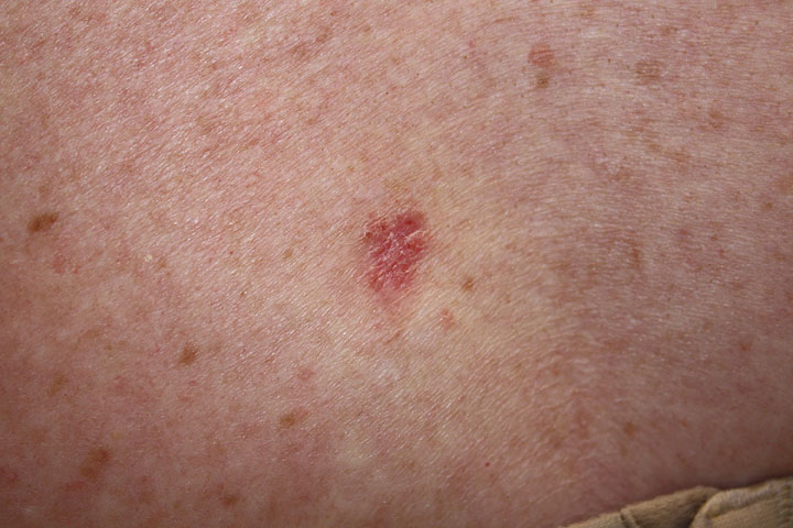 A Case of Basal Cell Cancer One close-up example of what Basal Cell Cancer often looks like.
