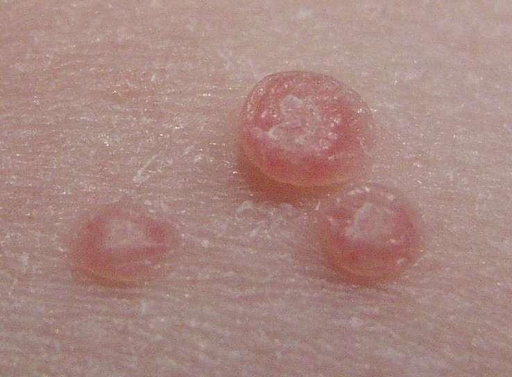 Skin Tags Some fairly atrocious looking skin tags seen on the hand.