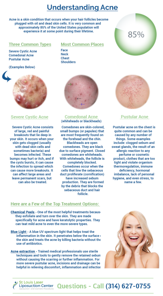 understanding-acne
