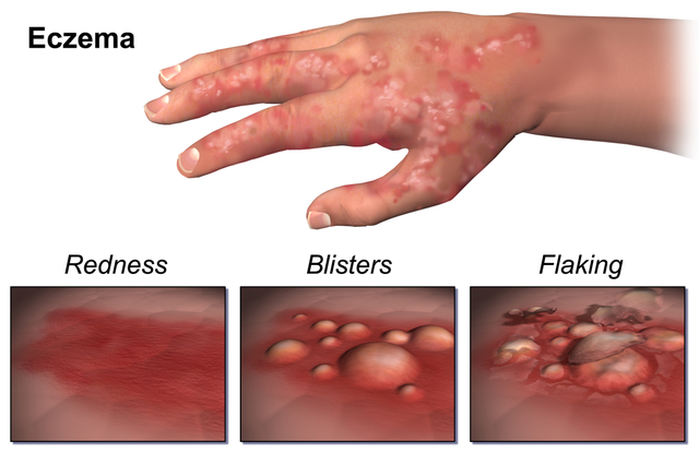 640px-eczema
