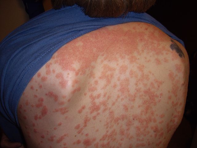 640px-guttate_psoriasis
