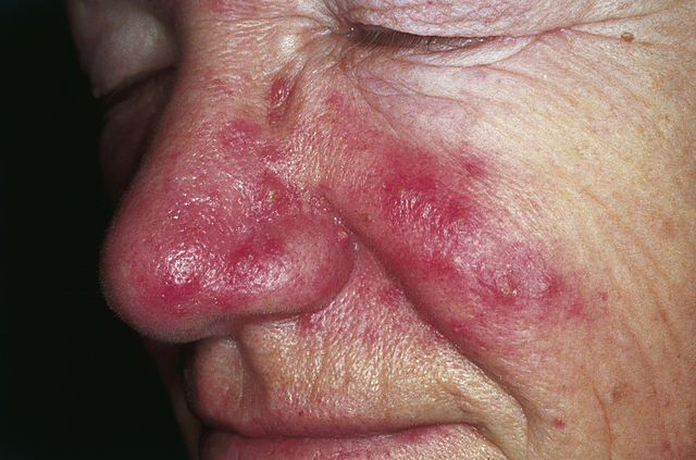 640px-rosacea_01