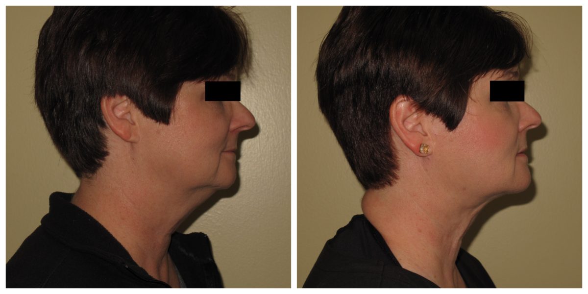 chin lipo before and after St Louis Lipo
