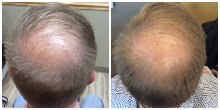 prp hair loss before and after prp hair loss before and after