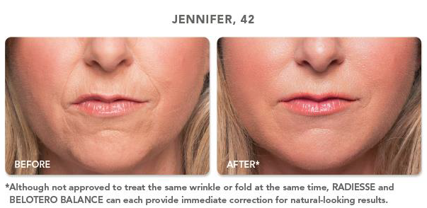 Belotero Balance for Wrinkle and Bolder Lips - St Louis Lipo