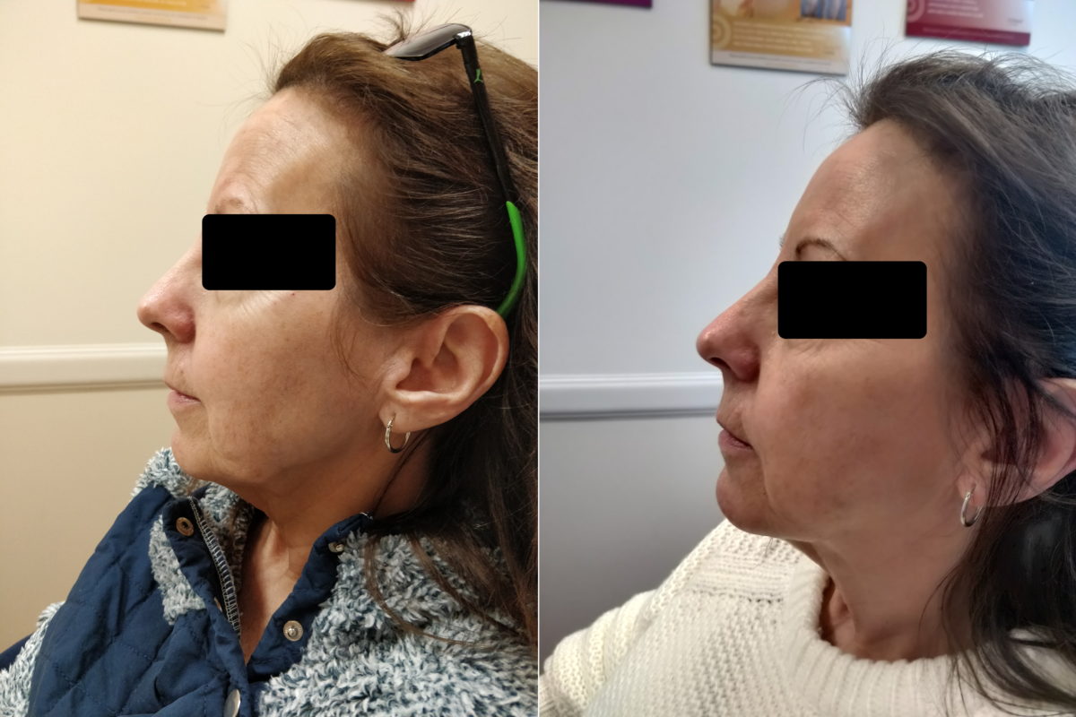 Botox, Xeomin & Dysport Comparison St. Louis Laser Liposuction Center