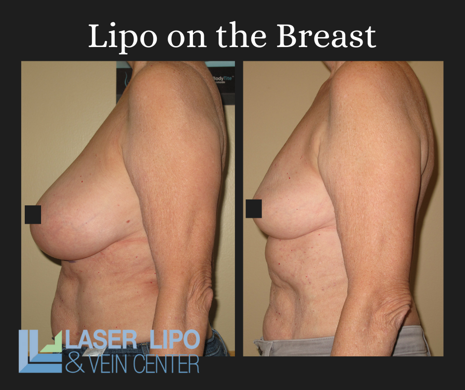 Breast Liposuction, Breast Reduction Surgery