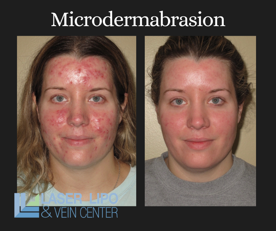 Microdermabrasion for Skin Rejuvenation and Acne Scars St Louis Laser Lipo