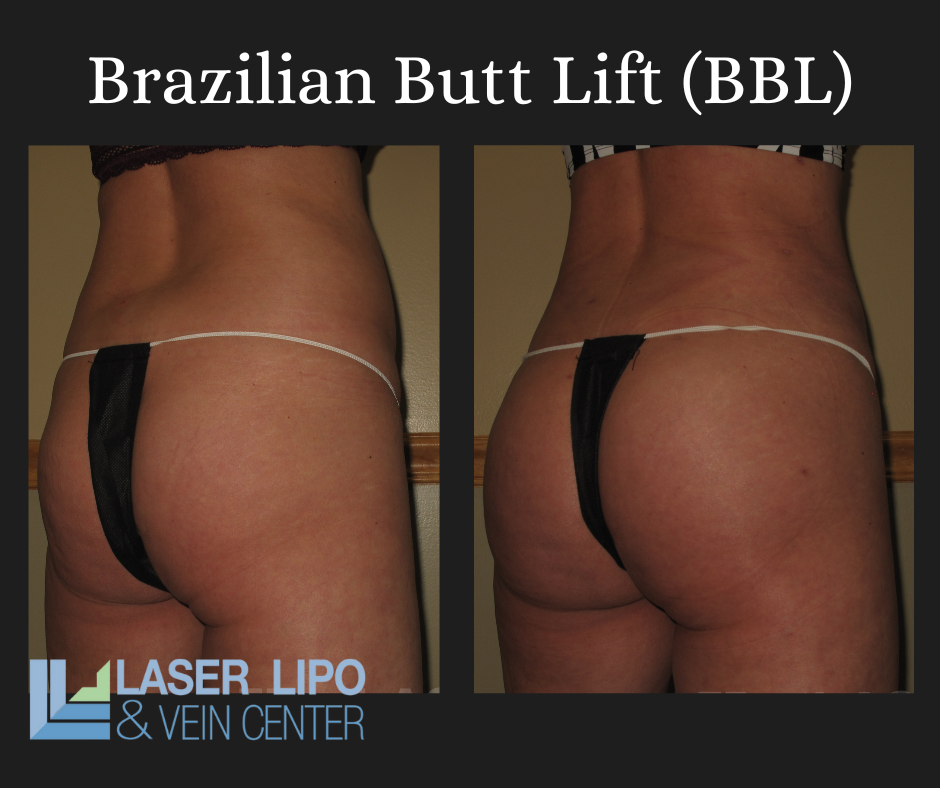 Natural Butt Augmentation and Brazilian Butt Lift