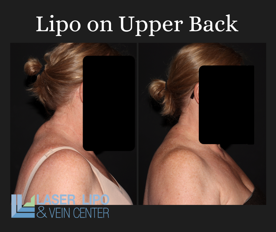 Bra Line and Mid/Upper Back Liposuction St. Louis Liposuction Center