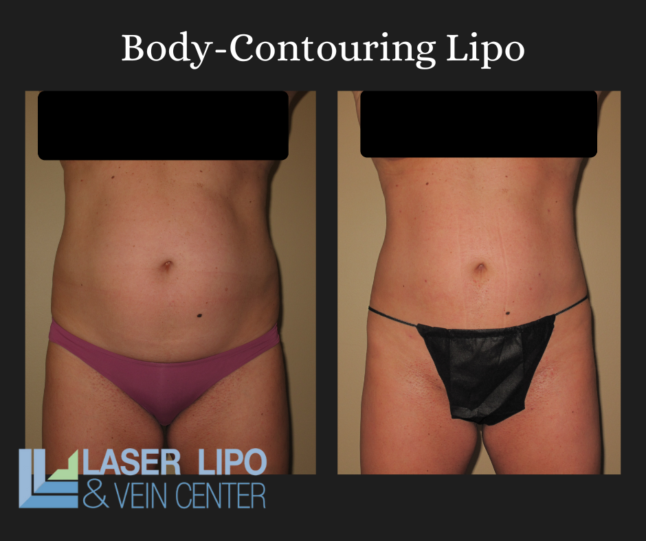 https://www.stlouislipo.com/wp-content/uploads/2022/06/Renuvion-Lipo-Before-and-After-1.png