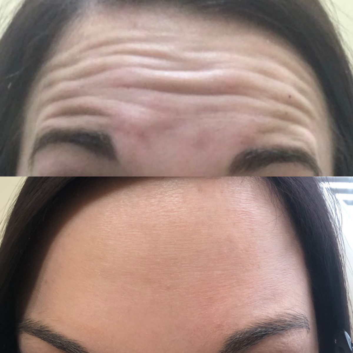 Botox, Xeomin & Dysport Comparison | St. Louis Laser Liposuction Center