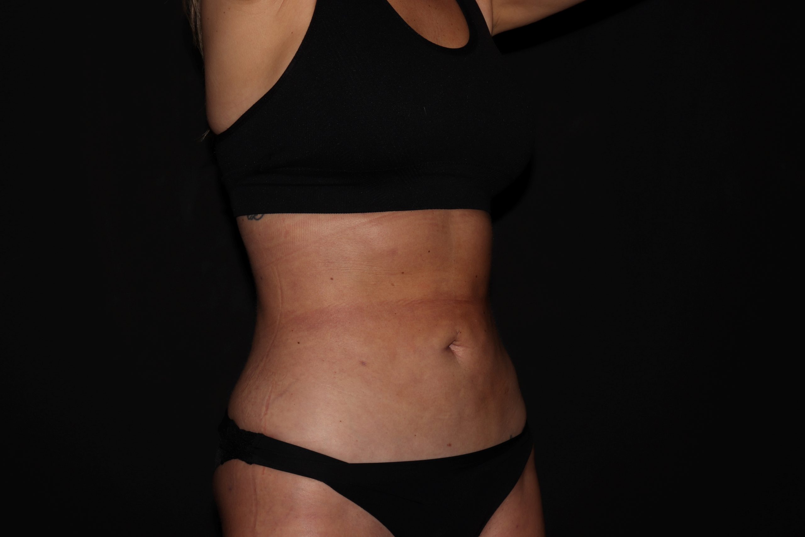 abdominal area after lipo