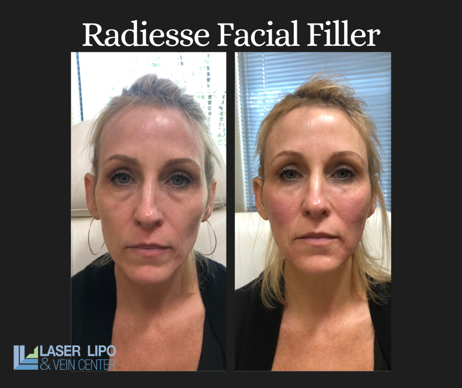 Radiesse Before And After Radiesse Before And After