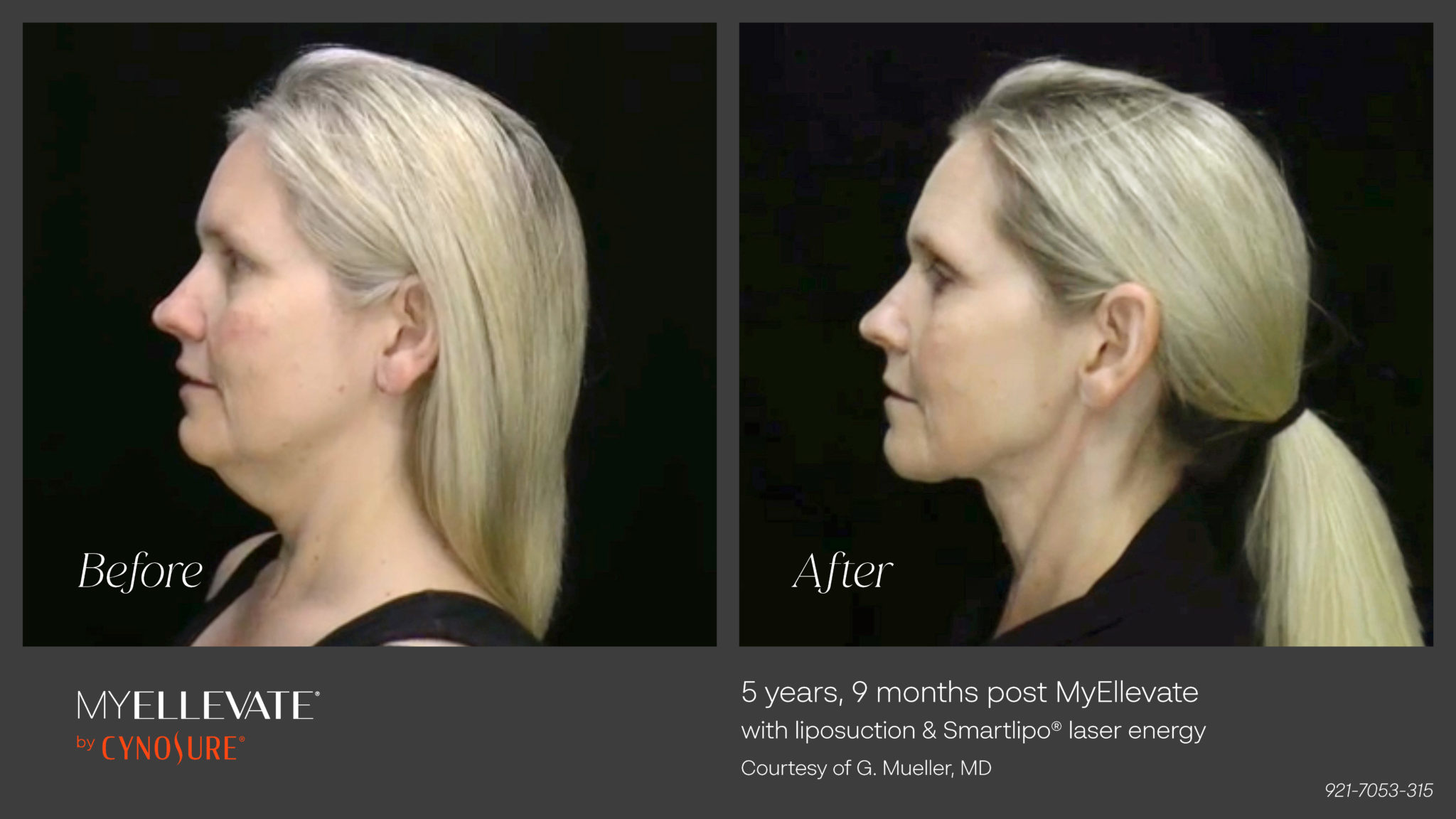 MinimallyInvasive Neck Lifts with MyEllevate St Louis Lipo