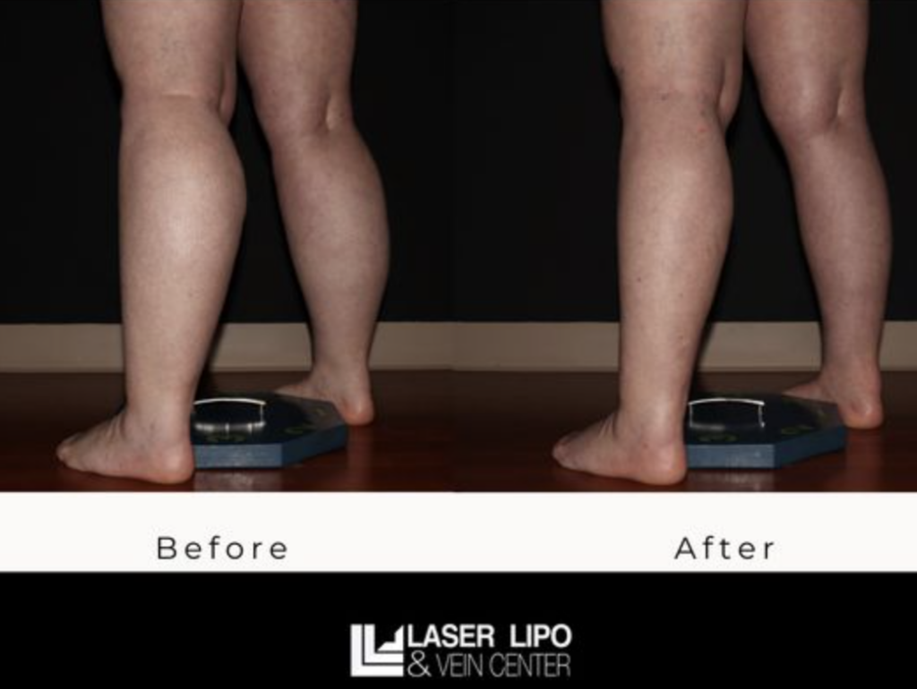 Lipo Calves Ankesl Before After St Louis Dr Wright St Louis Lipo